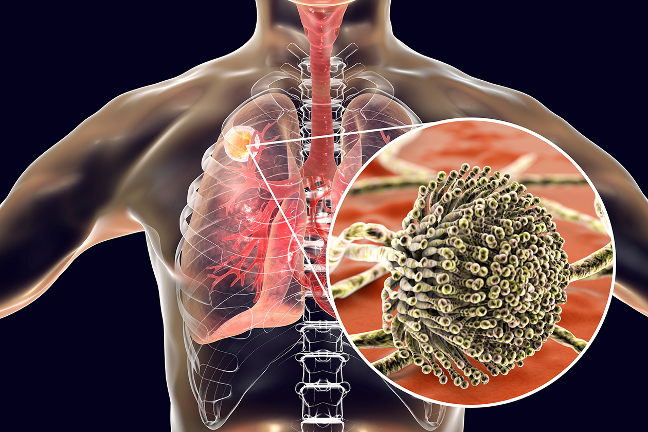 Health Effects Caused by Mold